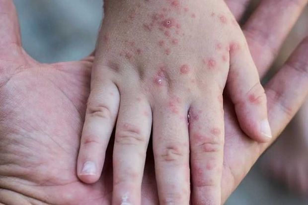 ust-avropada-qizilca-epidemiyasinin-sebebini-aciqladi